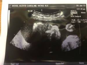 28 week scan; second trimester scan